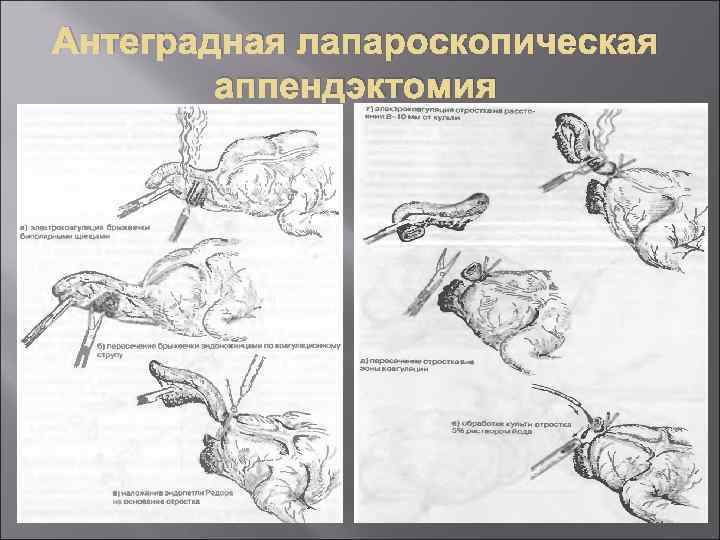 При типичной картине острого аппендицита операционным доступом является