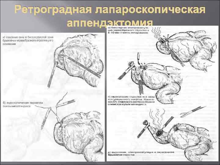 Ретроградная лапароскопическая аппендэктомия 