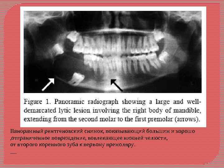 Панорамный рентгеновский снимок, показывающий большим и хорошо , отграниченное повреждение, вовлекающее нижней челюсти, от