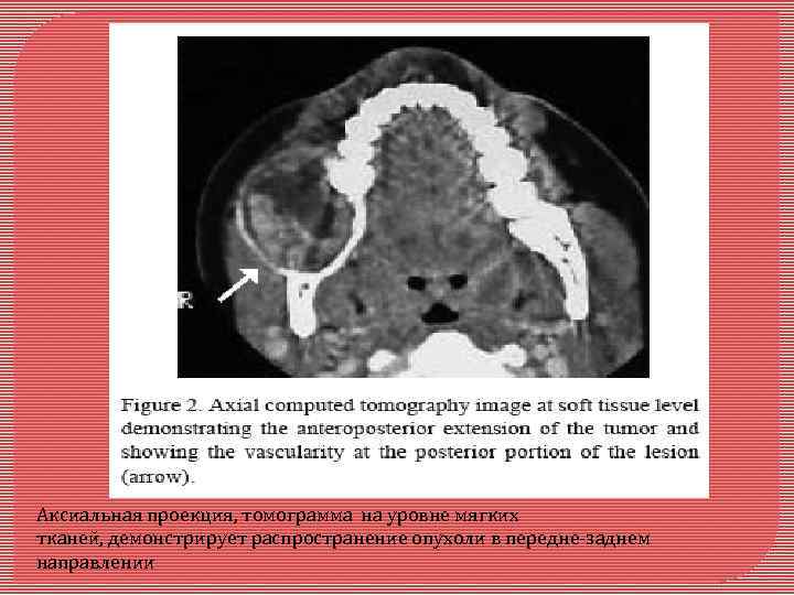 Аксиальная проекция, томограмма на уровне мягких тканей, демонстрирует распространение опухоли в передне-заднем направлении 