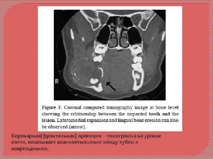 Коронарная(фронтальная) проекция - томограмма на уровне кости, показывает взаимоотношение между зубом и повреждением. 