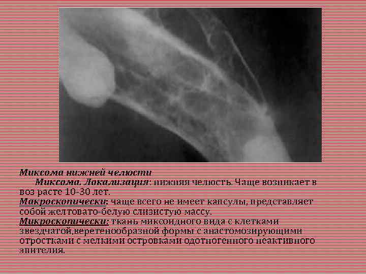 Миксома нижней челюсти Миксома. Локализация: нижняя челюсть. Чаще возникает в воз расте 10 -30