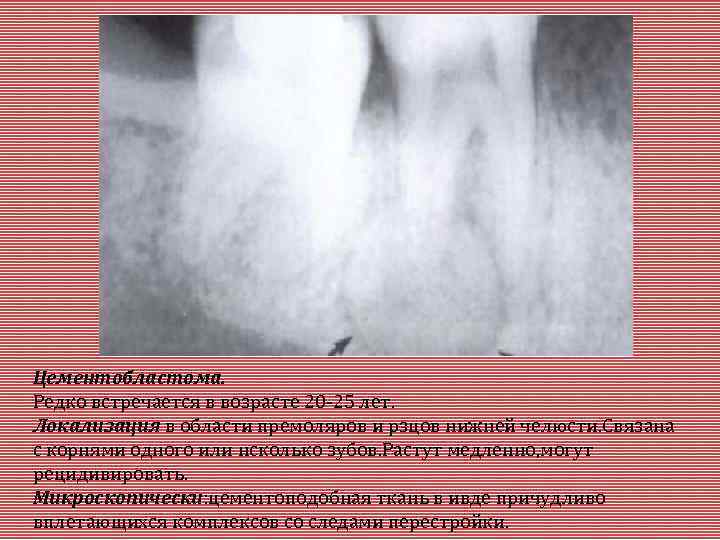 Цементобластома. Редко встречается в возрасте 20 -25 лет. Локализация в области премоляров и рзцов