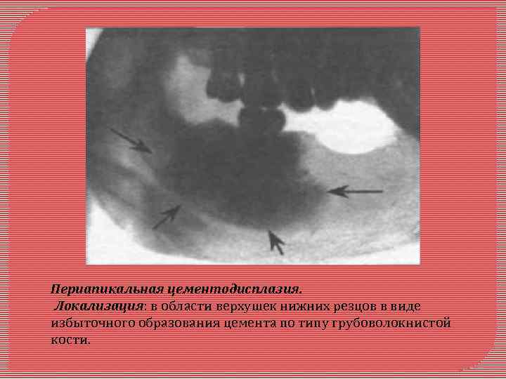 Периапикальная цементодисплазия. Локализация: в области верхушек нижних резцов в виде избыточного образования цемента по