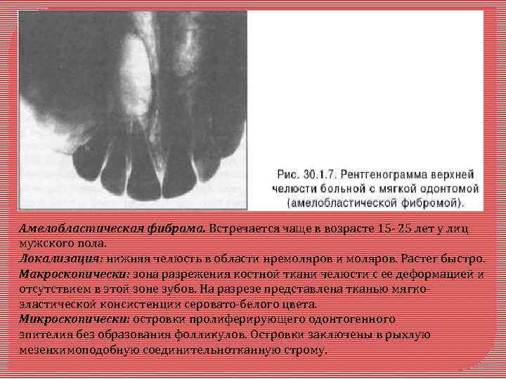 ›››››› Амелобластическая фиброма. Встречается чаще в возрасте 15 - 25 лет у лиц мужского