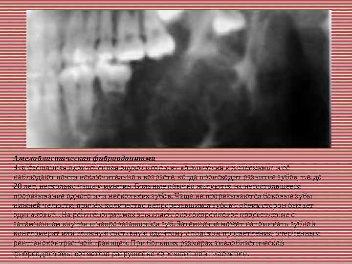 Амелобластическая фиброодонтома Эта смешанная одонтогенная опухоль состоит из эпителия и мезенхимы, и её наблюдают