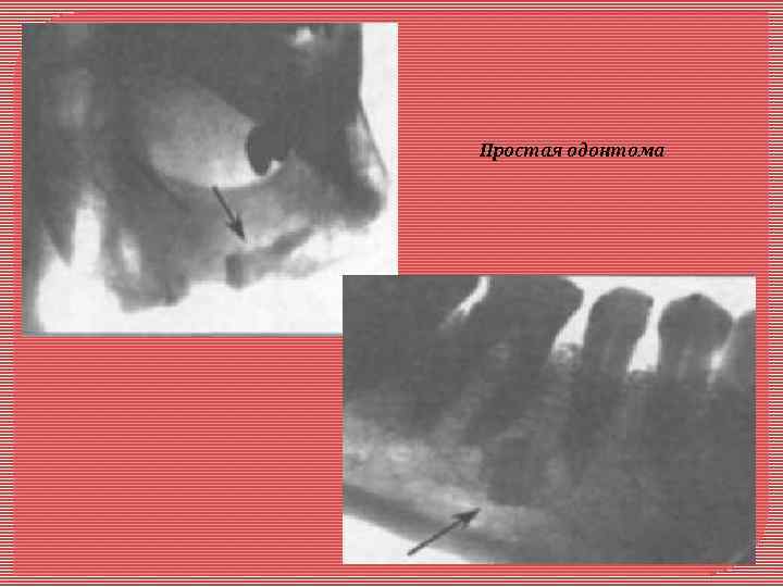 Простая одонтома 