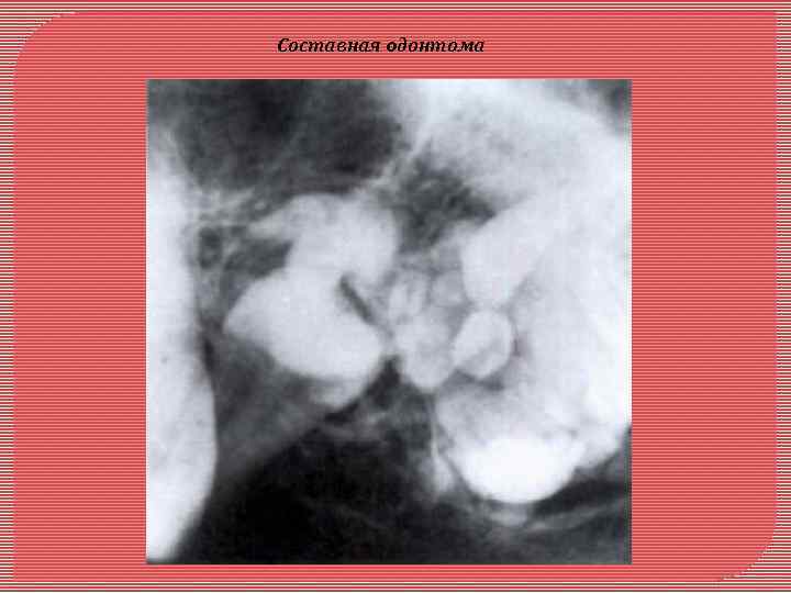 Составная oдонтома 