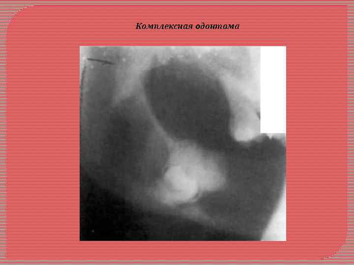 Комплексная oдонтома 