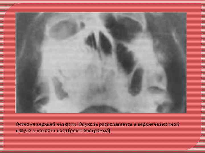 Остеома верхней челюсти. Опухоль располагается в верхнечелюстной пазухе и полости носа (рентгенограмма) 