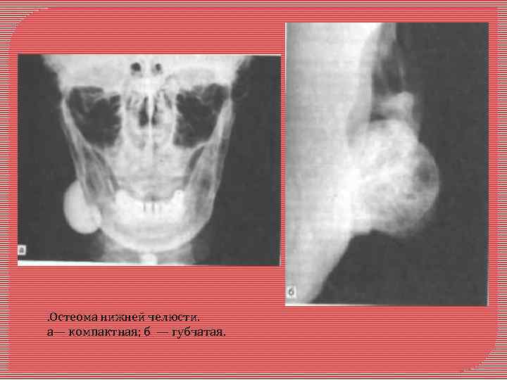 . Остеома нижней челюсти. а— компактная; б — губчатая. 