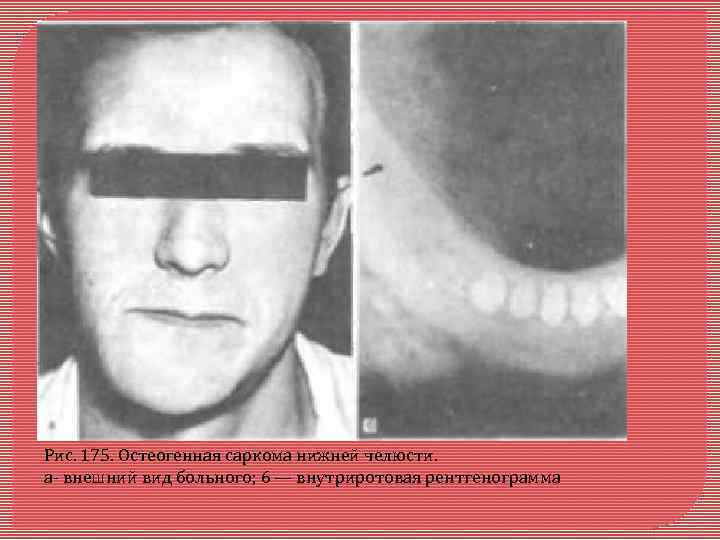 Рис. 175. Остеогенная саркома нижней челюсти. а- внешний вид больного; 6 — внутриротовая рентгенограмма