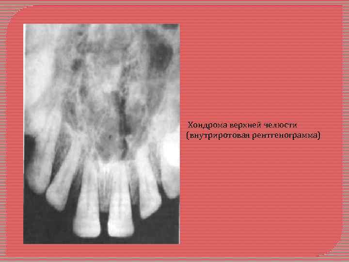Хондрома верхней челюсти (внутриротовая рентгенограмма) 