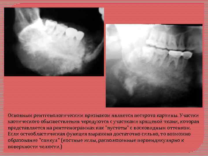 Основным рентгенологическим признаком является пестрота картины. Участки хаотического обызвествления чередуются с участками хрящевой ткани,