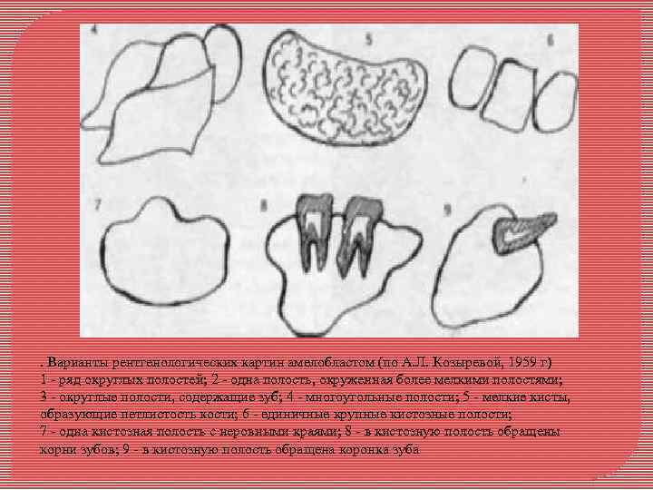 . Варианты рентгенологических картин амелобластом (по А. Л. Козыревой, 1959 г) 1 - ряд