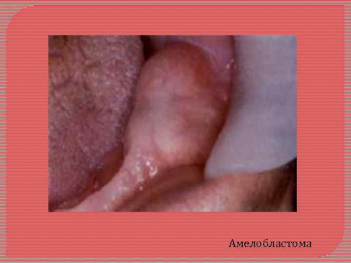 Амелобластома 