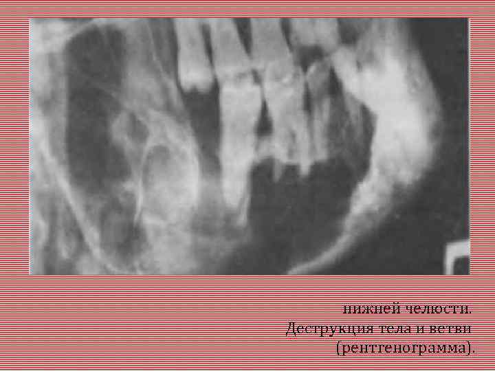 нижней челюсти. Деструкция тела и ветви (рентгенограмма). 