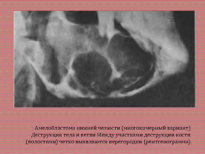 Амелобластома нижней челюсти (многокамерный вариант) Деструкция тела и ветви Между участками деструкции кости (полостями)