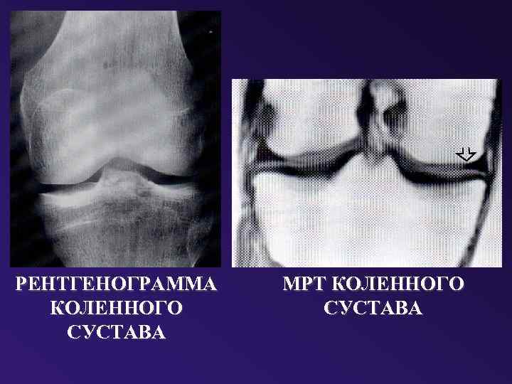 РЕНТГЕНОГРАММА КОЛЕННОГО СУСТАВА МРТ КОЛЕННОГО СУСТАВА 