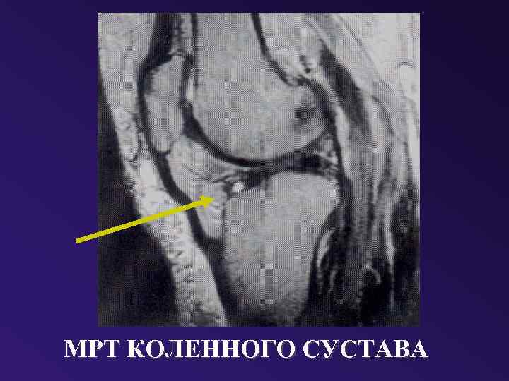 МРТ КОЛЕННОГО СУСТАВА 