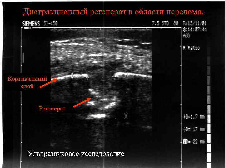 Дистракционный регенерат в области перелома. Кортикальный слой Регенерат Ультразвуковое исследование 