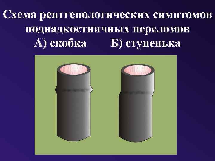 Схема рентгенологических симптомов поднадкостничных переломов А) скобка Б) ступенька 