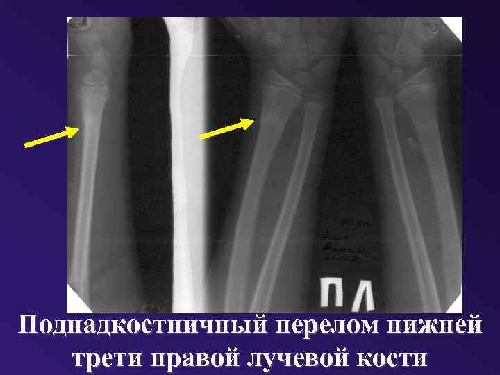 Поднадкостничный перелом нижней трети правой лучевой кости 