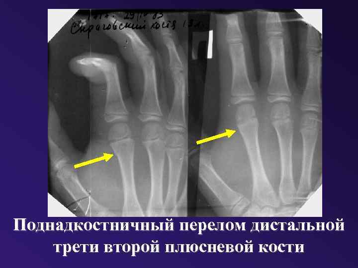 Поднадкостничный перелом дистальной трети второй плюсневой кости 