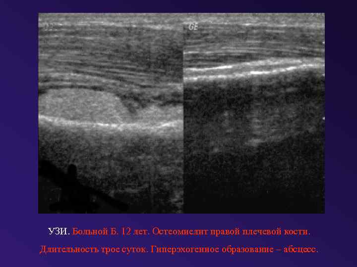 УЗИ. Больной Б. 12 лет. Остеомиелит правой плечевой кости. Длительность трое суток. Гиперэхогенное образование