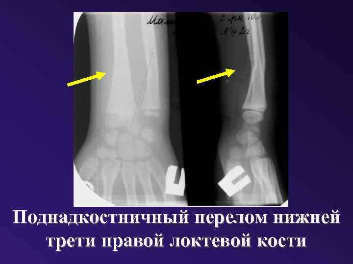 Поднадкостничный перелом нижней трети правой локтевой кости 