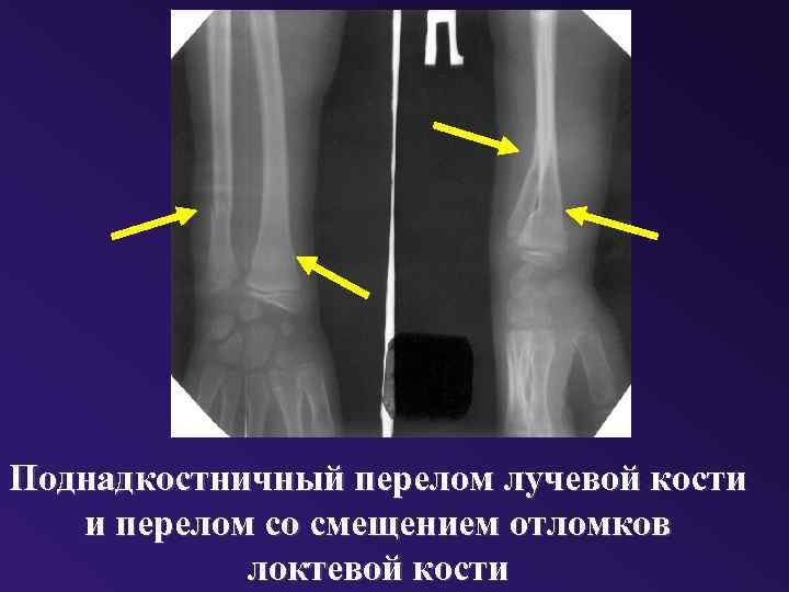 Поднадкостничный перелом лучевой кости и перелом со смещением отломков локтевой кости 