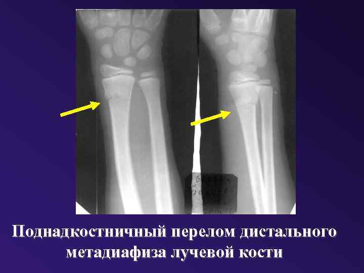 Лучевая кость перелом. Дистального метадиафиза лучевой кости. Перелом метафиза лучевой кости. Поднадкостничный перелом лучевой кости. Перелом дистального метадиафиза лучевой кости.