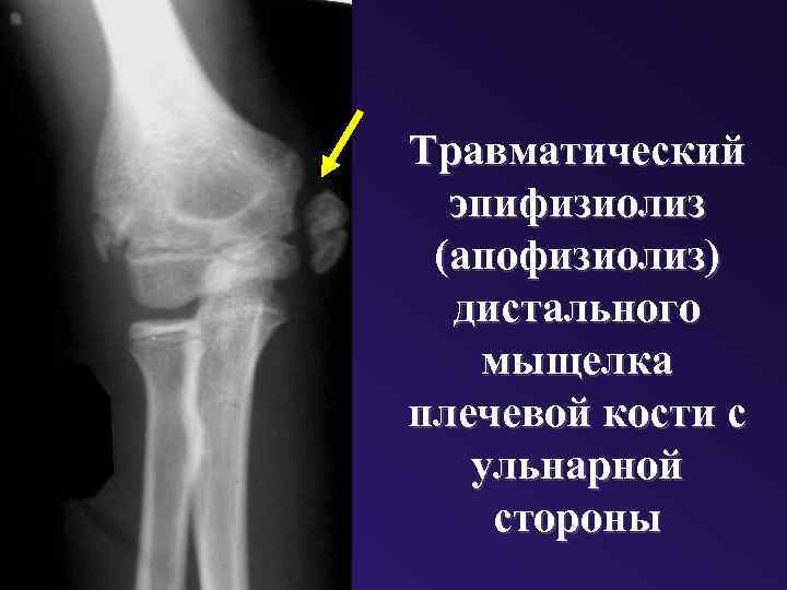 Травматический эпифизиолиз (апофизиолиз) дистального мыщелка плечевой кости с ульнарной стороны 