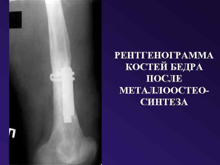 РЕНТГЕНОГРАММА КОСТЕЙ БЕДРА ПОСЛЕ МЕТАЛЛООСТЕОСИНТЕЗА 