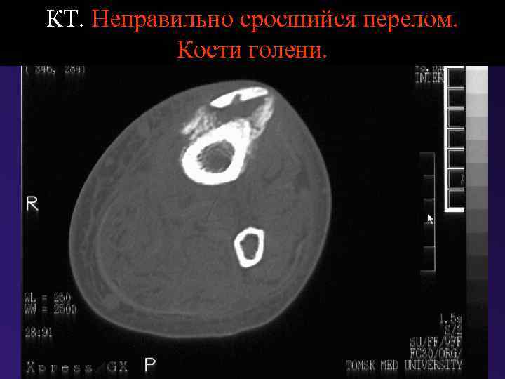 КТ. Неправильно сросшийся перелом. Кости голени. 