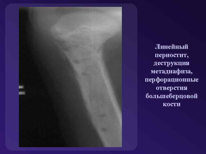 Линейный периостит, деструкция метадиафиза, перфорационные отверстия большеберцовой кости 