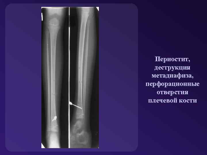 Периостит, деструкция метадиафиза, перфорационные отверстия плечевой кости 