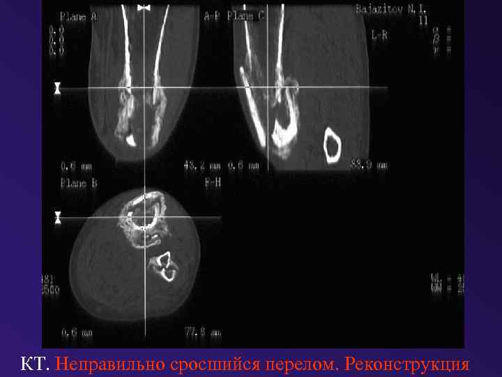 КТ. Неправильно сросшийся перелом. Реконструкция 