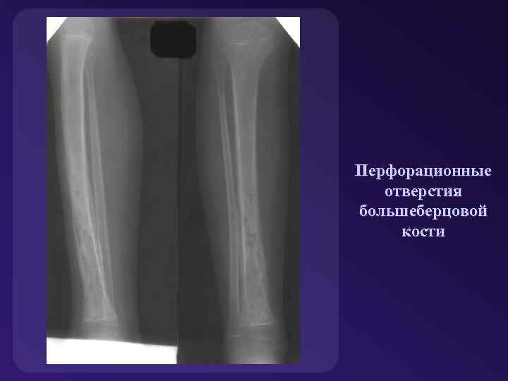 Перфорационные отверстия большеберцовой кости 