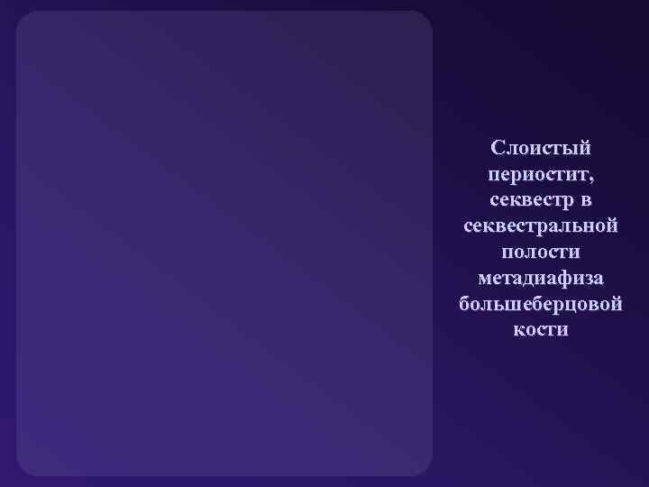 Слоистый периостит, секвестр в секвестральной полости метадиафиза большеберцовой кости 