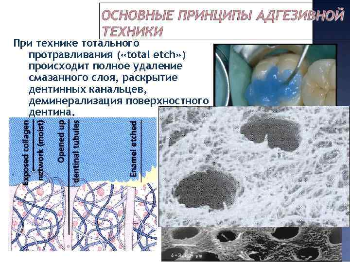 При технике тотального протравливания ( «total etch» ) происходит полное удаление смазанного слоя, раскрытие