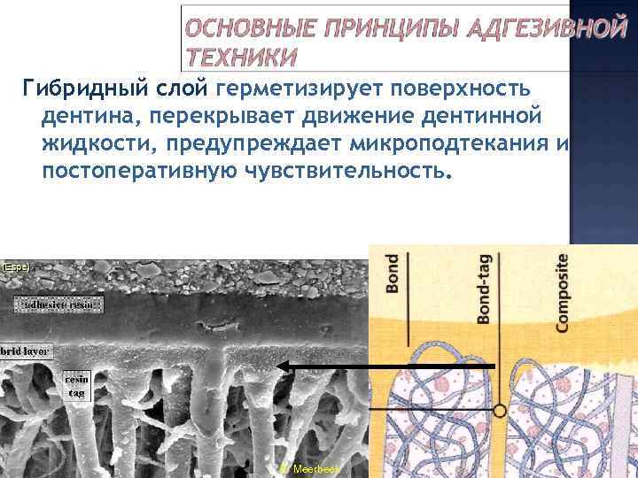 Гибридный слой герметизирует поверхность дентина, перекрывает движение дентинной жидкости, предупреждает микроподтекания и постоперативную чувствительность.