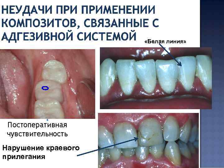  «Белая линия» Постоперативная чувствительность Нарушение краевого прилегания 