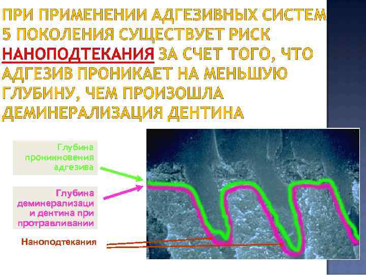 Глубина проникновения адгезива Глубина деминерализаци и дентина при протравливании Наноподтекания 