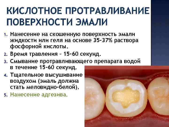 Полость применять. Протравливание эмали и дентина проводится для. Кислотное протравливание дентина. Кислота для протравливания эмали зуба.