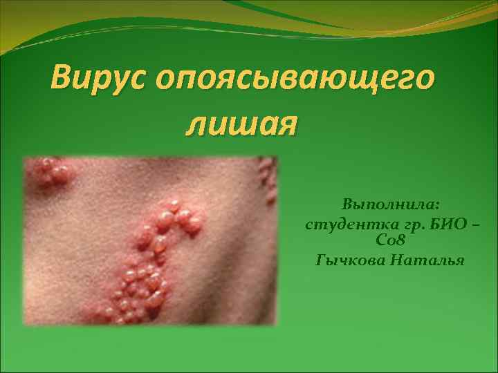 Вирус опоясывающего лишая Выполнила: студентка гр. БИО – С 08 Гычкова Наталья 
