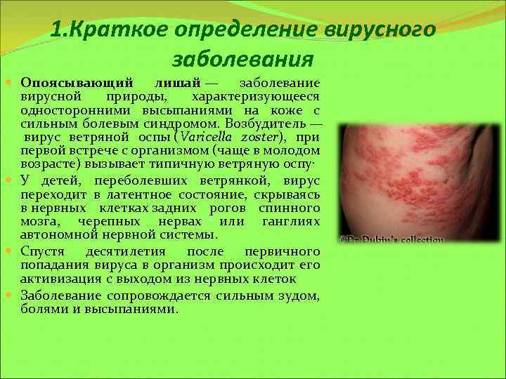 1. Краткое определение вирусного заболевания Опоясывающий лишай — заболевание вирусной природы, характеризующееся односторонними высыпаниями