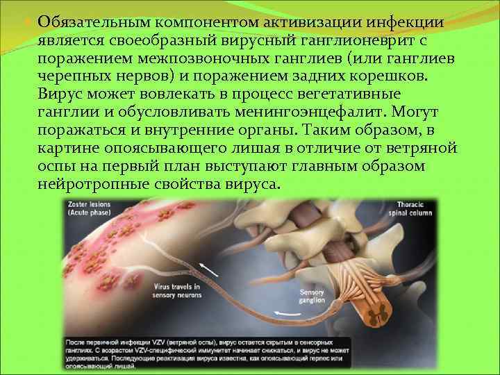  Обязательным компонентом активизации инфекции является своеобразный вирусный ганглионеврит с поражением межпозвоночных ганглиев (или