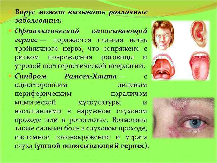 Вирус может вызывать различные заболевания: Офтальмический опоясывающий герпес — поражается глазная ветвь тройничного
