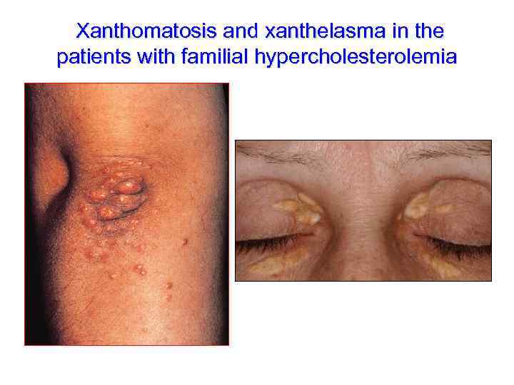 Xanthomatosis and xanthelasma in the patients with familial hypercholesterolemia 